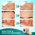 Silicone Scar Sheets,Silicone Scar Tape - Image 3